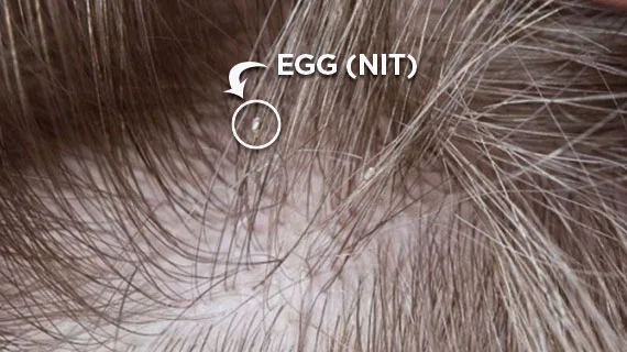 Lice eggs, or nits, are extremely small.